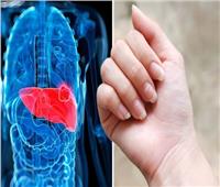علامة في أصابعك تشير إلى خطر الإصابة بمرض الكبد الدهني
