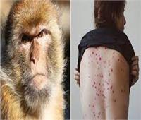 فنزويلا تؤكد اكتشاف أول إصابة بجدري القرود في البلاد