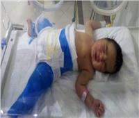 نجاح جراحة بمفصل الحوض الأيسر لرضيعة عمرها أربعة أيام بالبحيرة