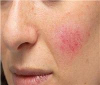 3 علامات تحذيرية تظهر في الوجه تدل على الإصابة بالسرطان    