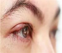 7 علاجات منزلية لـ«ندبة العين»