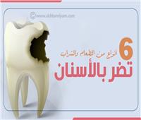 إنفوجراف| 6 أنواع من الطعام والشراب تضر بالأسنان