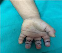 «كانت بتلعب بمفرمة لحمة».. فريق طبي ينقد يد طفلة من البتر بالغربية  