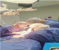 إجراء جراحة لطفلين حديثي الولادة يعانيان من عيب خلقي في المنيا 