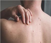 علامات تحذيرية قد تشير إلى خطر الإصابة بسرطان الجلد 