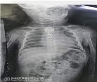 فريق طبي بمستشفى بنها  ينجح في استخراج جسم معدني ابتلعه طفل