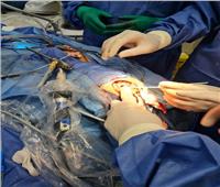 إجراء أول جراحة إزالة ورم بالمخ عن طريق المنظار بمستشفى بني سويف الجامعي