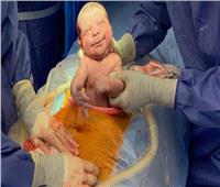 نقابة الأطباء: الولادة القيصرية تزيد معدل دخول الطفل للحضانات 3 أضعاف