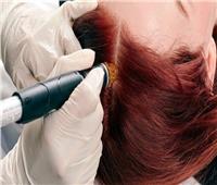 لعلاج الشعر الجاف.. خبراء ينصحون بتقشير فروة الرأس أسبوعياً  
