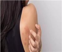 5 أسباب رئيسية تؤدي للإصابة بحساسية الجلد