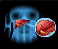 دراسة | الأنظمة الغذائية الغنية بالالياف المصنعة تسبب سرطان الكبد       