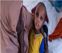لسوء التغذية..اليونيسف تحذر من وفيات غير مسبوقة بين الأطفال بالصومال