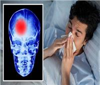 دراسة أمريكية: الإنفلونزا مرتبطة بزيادة خطر الإصابة بالسكتة الدماغية