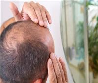 لأول مرة.. خبراء يزرعون الشعر في مختبر لعلاج الصلع عند الرجال