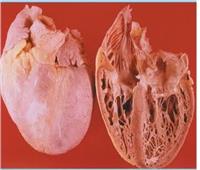 دراسة: اعتلال عضلة القلب سبب حالات الوفاة المفاجئة عالميًا   