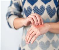 هل تعاني من « الجلد المتقشر»؟.. 5 علاجات منزلية لمرض الصدفية
