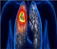  يسبب «سرطان الرئة».. استشاري علاج الأورام يحذر من الجلوس مع المدخنين | فيديو
