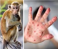 هاني الناظر بعد رصد إصابة بجدري القرود في مصر: ليس وباء
