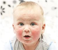 كيف تحمي بشرة طفلك من أكزيما الشتاء؟ 
