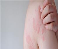 «انحلال الجلد الفقاعي».. ما هو وأعراضه وأنواع وطرق الوقاية منه؟