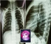 طبيب يعثر على «سوستة حديدية» داخل رئة طفل       
