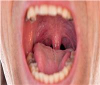 جفاف الفم أحد أعراض «العلم الأحمر» لخمسة أمراض خطيرة.. أبرزها الزهايمر