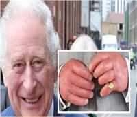 «أصابع السجق».. لماذا تظهر يد الملك تشارلز ضخمة في الصور؟| صور 