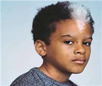 أسباب ظهور الشعر الأبيض للأطفال.. وكيفية علاجه؟