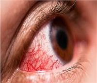 «إحذر إحمرار العين في الصيف» علامة للإصابة بأمراض أبرزها الحساسية