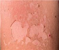 كيف تتعامل مع تقشير الجلد بعد احتراقه من الشمس؟  