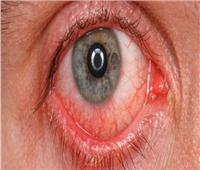أبرزها احمرار العين و تشوش الرؤية.. تعرف على التهاب العنبية