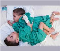 في عملية تستغرق 9 ساعات| غدا فصل «إحسان وبسام» توأم سيامي سوري بالرياض 
