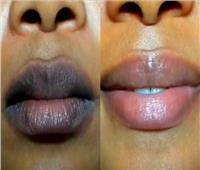 5 طرق طبيعية لعلاج سواد الشفايف عند الرجال