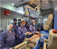 فريق طبي بـ«الحسين الجامعي» ينجح في تغيير الصمام الأورطي لمُسن 75 عاماً