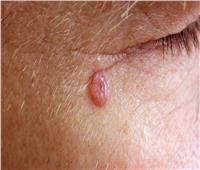 الأعراض الرئيسية لسرطان الجلد «غير الميلانيني»