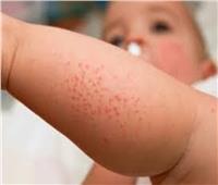 أخصائي جلدية: جسم الأطفال حساس جدًا ويحتاج لمعاملة خاصة
