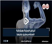 أعراض الإصابة بهشاشة العظام وطرق علاجها | فيديو 