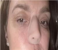 امرأة بلا أنف.. تشخيص خاطيء يغير حياتها | صور