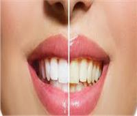 تبييض الأسنان ـ استعادة الابتسامة البيضاء