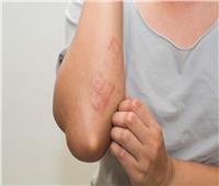 علامات على الجلد قد تكون مؤشراً لأمراض خطيرة