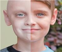 في يومه العالمي| أعراض عامة لسرطان الأطفال.. تعرف عليها