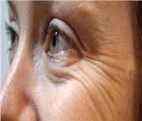 استشاري أمراض جلدية: التعرض لأشعة الشمس سبب تكوين تجاعيد الوجه