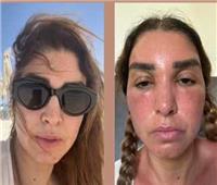 حتى لا تلاقي مصير روجينا.. كيف تحمي نفسك من أشعة الشمس؟