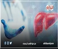 انفوجراف | الاحصائيات العالمية للإصابة والوفاة بالالتهاب الكبدي c-b