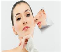 علاجات طبيعية للتخلص من آثار حب الشباب