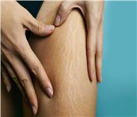الصبار الأبرز.. أفضل 5 علاجات طبيعية للتخلص من علامات التمدد