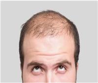طول أصابعك قد يكشف احتمالات إصابتك بالصلع