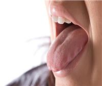 لسانك مرآة صحتك.. كيف؟