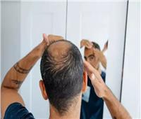 للرجال.. أخطاء تتسبب في اصابتك بالصلع