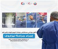 نجاح أول جراحة «ليزاروف» في مستشفى اليوم الواحد برأس البر